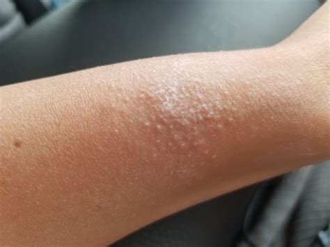 I Have Hundreds Of Itchy Bumps All Over My Bodylooks Like Flea Bites