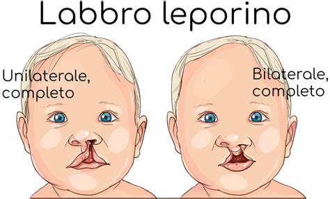 Labbro Leporino Cause Conseguenze E Cura Valori Normali