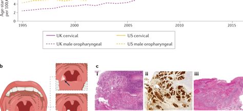 Hpv Associated With One Third Of Throat Cancer Cases Healthy Food Near Me