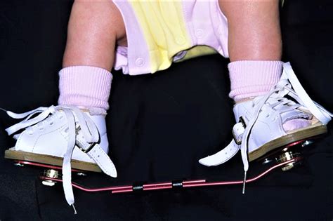 Club foot is the most common congenital disorder of the legs that can range from mild to severe. Club Foot - Congenital Clubfoot Causes, Types, Symptoms ...