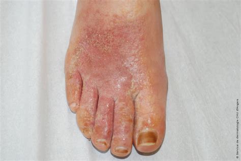 Eczema Bottom Of Feet
