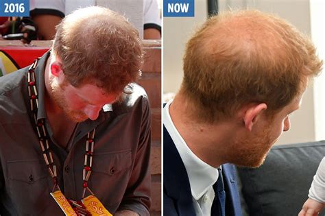 Balding Prince Harry Visits A Hair Loss Clinic For Thickening