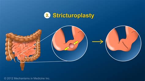 A Stricturoplasty Can Relieve Obstruction But Does Not Remove Any Portion Of The Intestine The