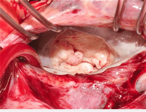 En Face Surgeon S View Of The Mitral Valve Both Mitral Leaflets And Download Scientific