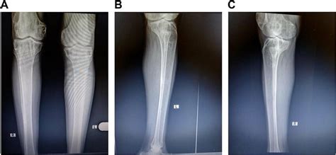 A Pa X Ray Of Tibia Cystic Lesion Of Distal Metaphysis Of Femur And