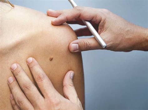 Removing moles can be a tricky task, but it is something that your doctor can do. How to Remove Moles: Safe Home Remedies