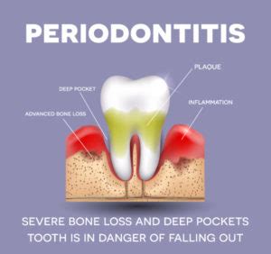 How to regrow bone loss from periodontal disease naturally. How LANAP® Can Fix Loose Teeth and Reverse Bone Loss