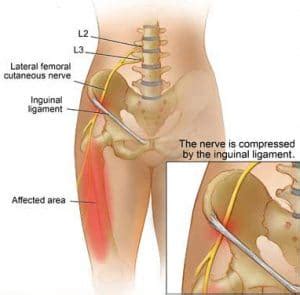 Meralgia Paresthetica Leg Pain Diagnosis Treatment