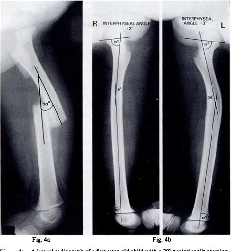 Pdf Remodelling Of Angular Deformity After Femoral Shaft Fractures In