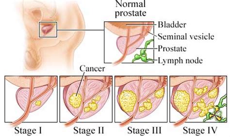Prostate cancer risk appears to be inversely correlated with the number of cag repeats in the ar. Prostate cancer treatment in Israel
