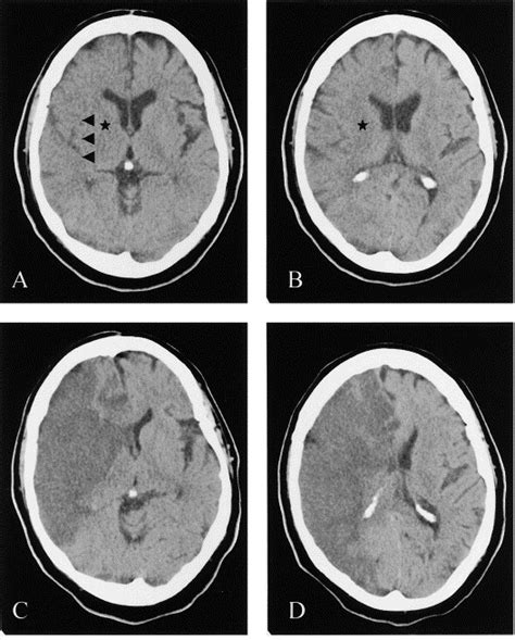 Evidence Based Neuroimaging In Acute Ischemic Stroke Neuroimaging Clinics