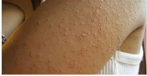She Develops Itchy Red Bumps All Over Her Arms But No One Knew It Was