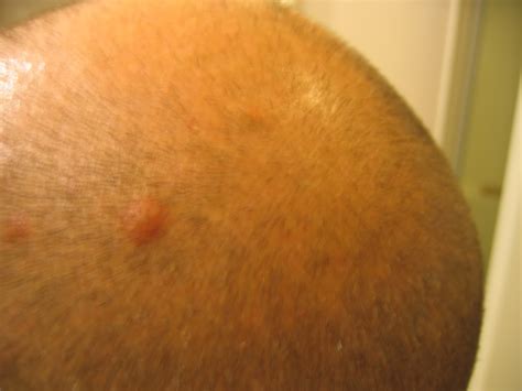 Red Bumps On Scalp Dorothee Padraig South West Skin