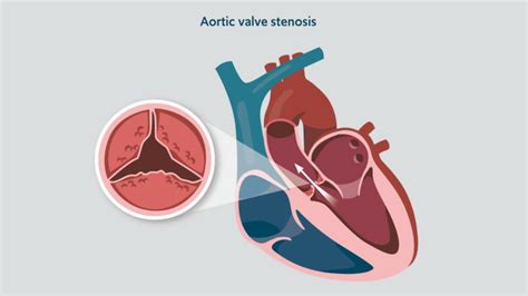 Aortic Stenosis Heart Conditions Rbandhh Specialist Care