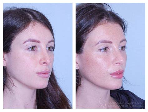 Rhinoplasty Cosmetic Surgery Vancouver Bc