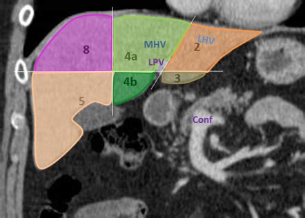 Liver Segments Annotated Ct Coronal Radiology Case Radiopaedia Org