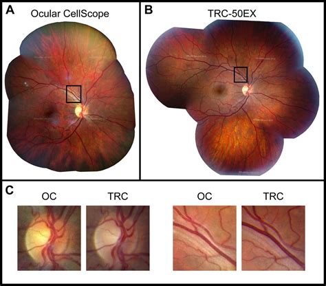 A Mobile Phone Based Retinal Camera For Portable Wide Field Imaging