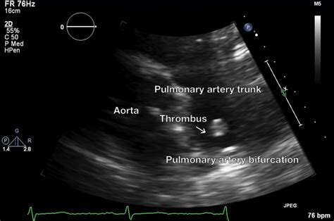 A Case Of Saddle Pulmonary Embolus Visualized On A Transthoracic Echocardiography In A 69 Year