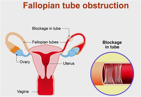 Blocked Fallopian Tubes Symptoms Causes And Treatment For Fertility