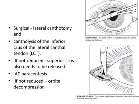 Blunt Ocular Trauma Ppt