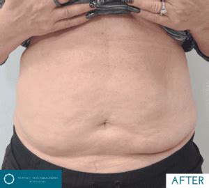 Emerald Laser Treatment Fat Loss Obesity Treatment Perfect Skin Solutions Portsmouth Uk