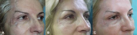 A 59 Year Old Female Patient That Underwent Microneedling Assisted