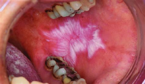 Oral Lichen Planus In The Left Buccal Mucosa With A Central Ulceration Download Scientific Diagram