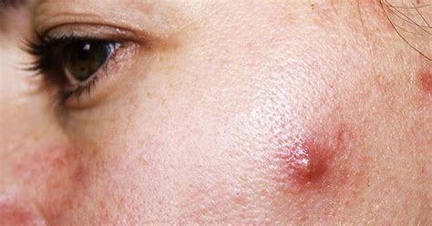 5 Types Of Bumps And Blemishes You Should Never Try To Pop