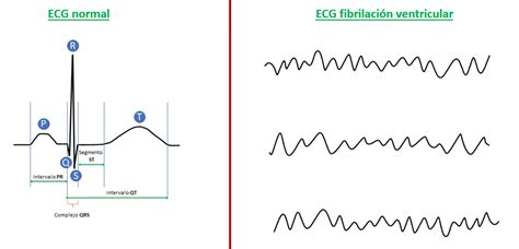 Ecg De La Fibrilación Ventricular Explicación Sencilla