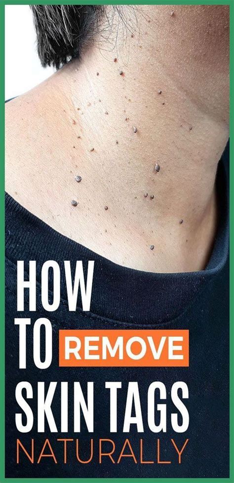 12 incredible home remedies to remove skin tags skin tag removal skin tag remove skin tags