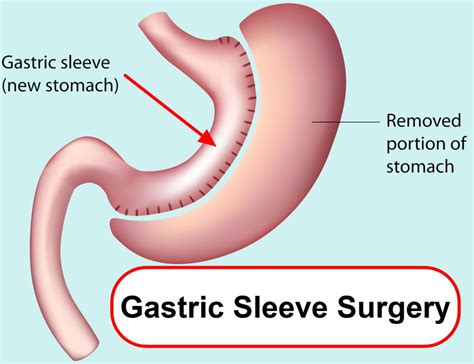 Gastrectomy Types Post Gastrectomy Diet And Life After Total Gastrectomy