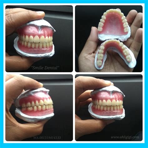 1. Pemasangan Gigi Palsu