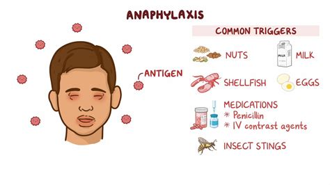 Anaphylaxis Clinical Sciences Osmosis Video Library