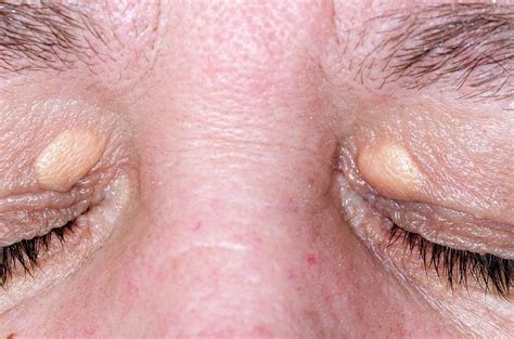 Xanthelasma On The Eyelids Photograph By Dr P Marazziscience Photo