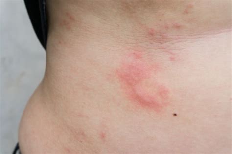 Pruritic Urticarial Papules And Plaques Of Pregnancy First Trimester