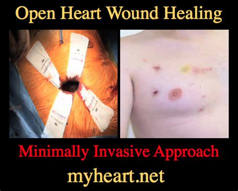 Open Heart Surgery Incredible Picture Guide Myheart