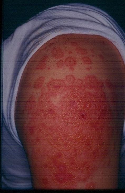 Dermatitis Ekzema Allergic Contact Dermatitis Picture Hellenic