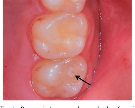 Figure 2 From Dens Evaginatus On Occlusal Surface Of Maxillary Second