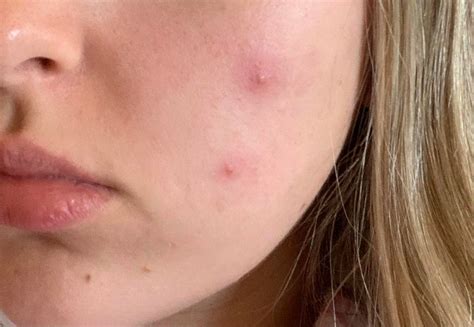 Acne I Had Cystic Acne Appear Overnight Any Advice On How To Clear