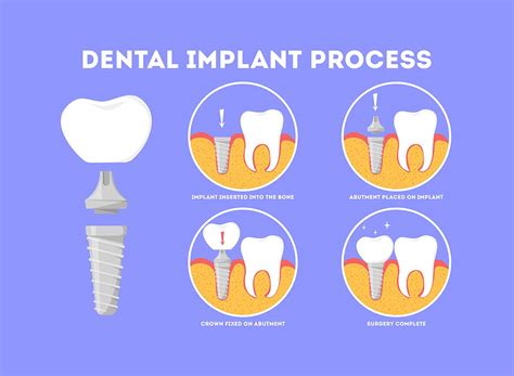 How Do Dental Implants Work Omega Dental Houston Tx