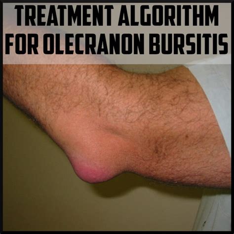 Treatment Algorithm For Olecranon Bursitis Sports Medicine Review