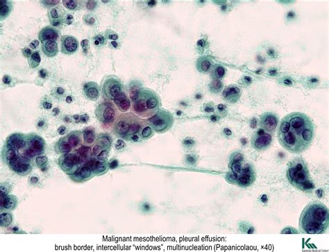 Pathology is one of the most essential fields in usmle step.it aims to. Mesothelioma Vs Carcinoma - Creative Art