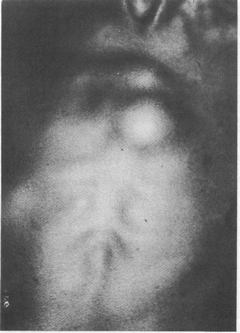 Case 2 Cold Abscesses Overlying The Manubrium And Body Ofthe Sternum