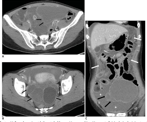 Figure 3 From Ct Imaging Findings Of Ruptured Ovarian Endometriotic Cysts Emphasis On The