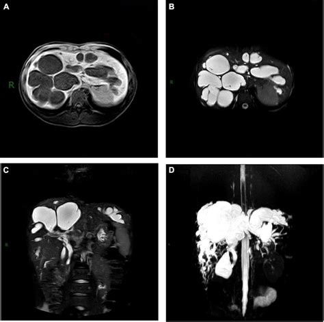 Magnetic Resonance Cholangiopancreatography Mrcp Of Carolis Disease