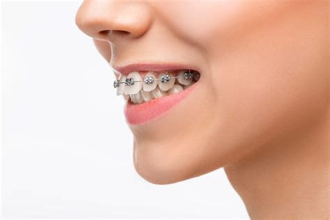 5 Common Orthodontic Myths Busted Dillehay Orthodontics Blog