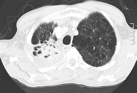 Atypical Mycobacteria Slideshow