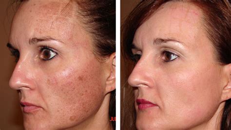Enlarged Pores Treatment Minneapolis Skin Rejuvenation Clinic