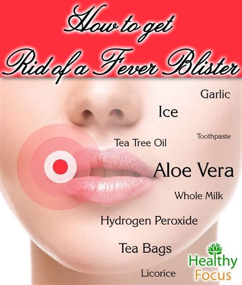 perfect how to get rid of fever blisters on your lip fast and view in 2020 fever blister