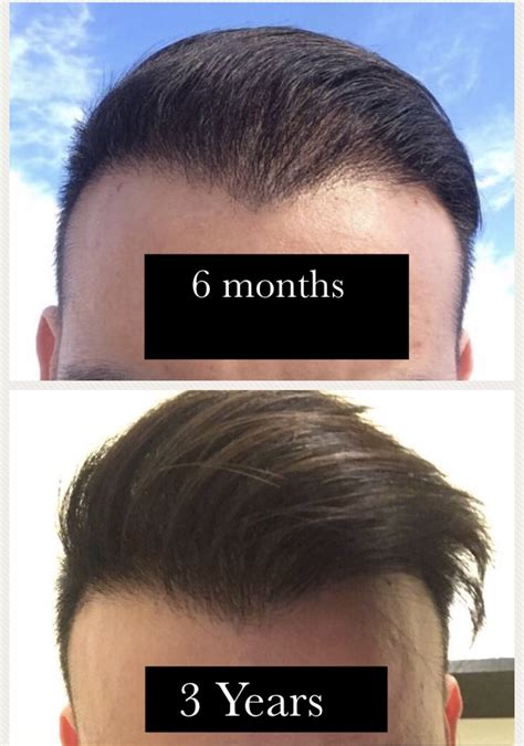 Волосы форум мужчины. 6 Months of growth hair. Hair transplant month timeline.